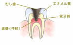 C3：神経のむし歯